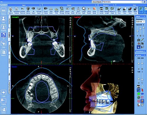 3D stomatoloģiskais panorāmas rentgens
